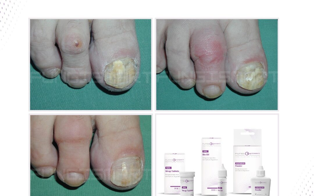 Schimmelnagels: wat je erover moet weten.